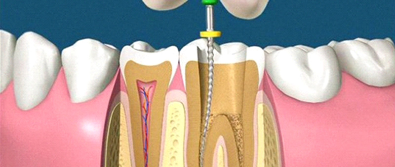 Il dente devitalizzato: puo' scurirsi o rompersi ?