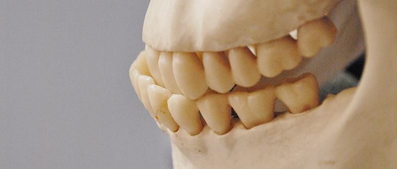 Denti storti, ne soffrono 3 italiani su 5