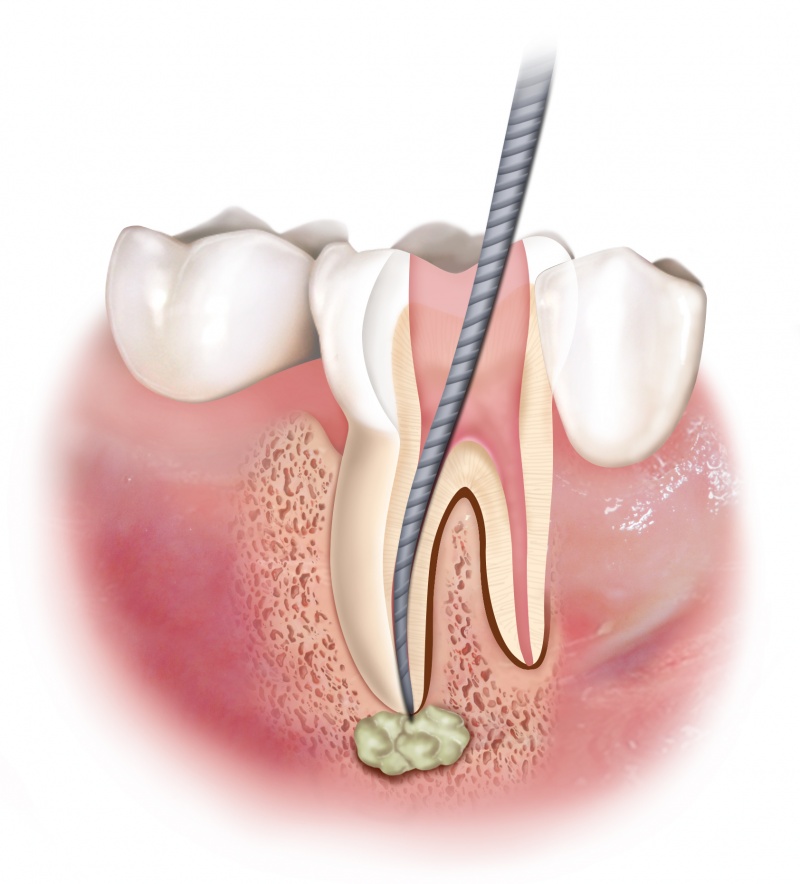 Endodonzia Pagano Lauro