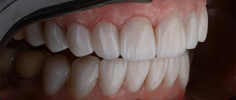 Faccette dentali