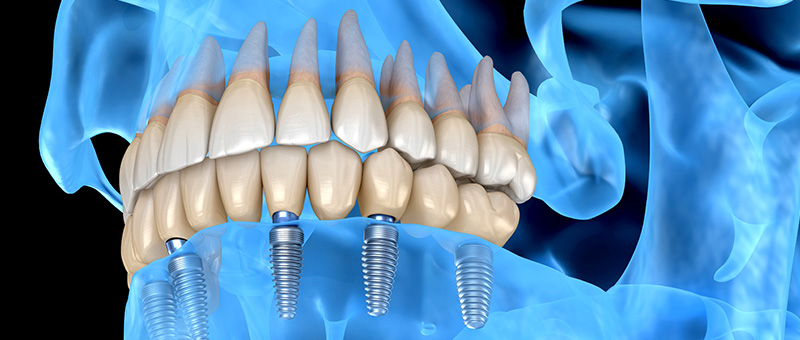 Impianti dentali: forse non sai che è possibile posizionarli anche se non c’è molto osso