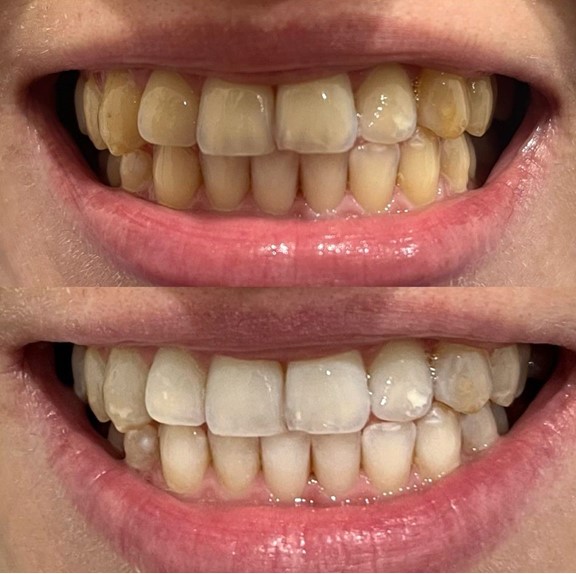 Sbiancamento dentale professionale